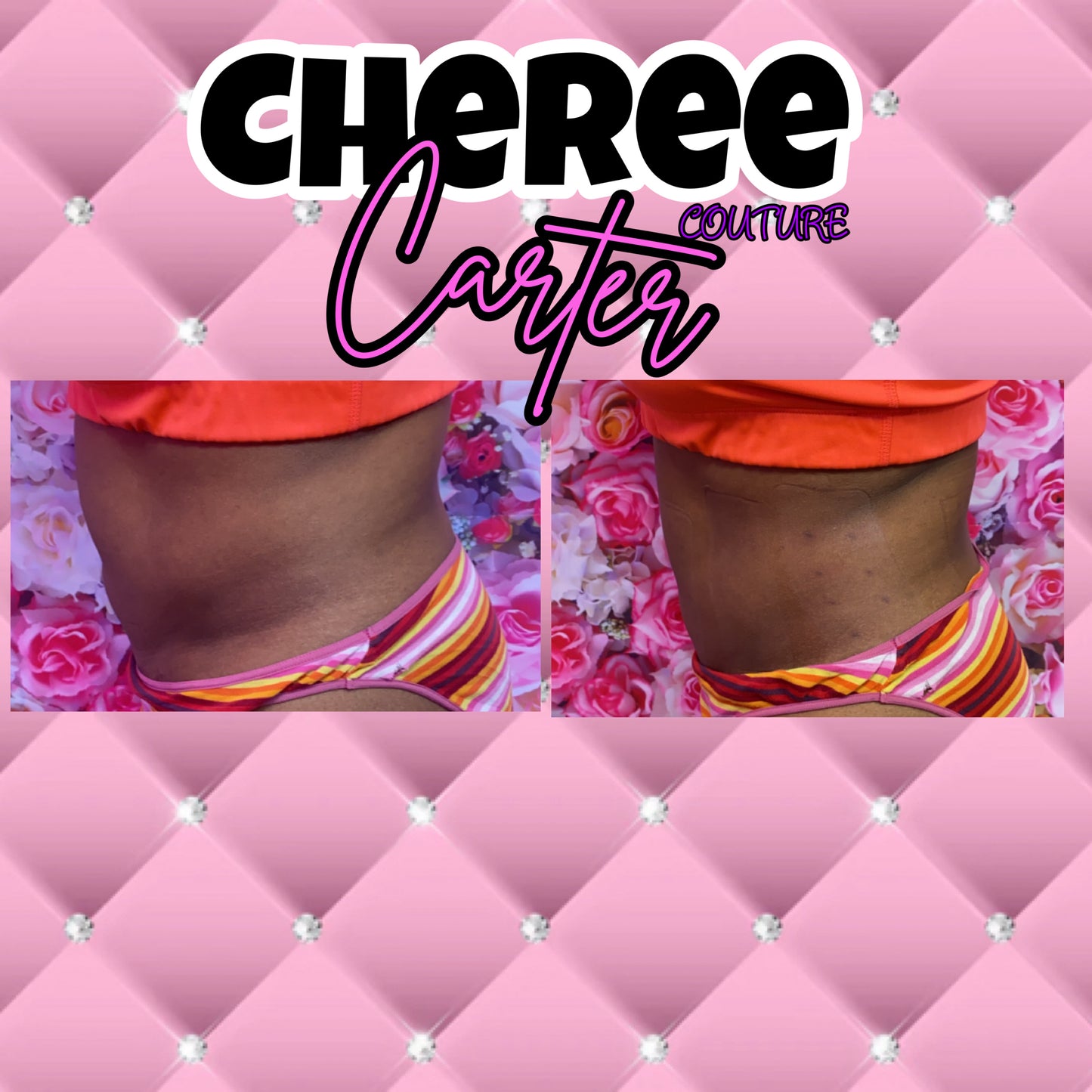 Laser Lipo