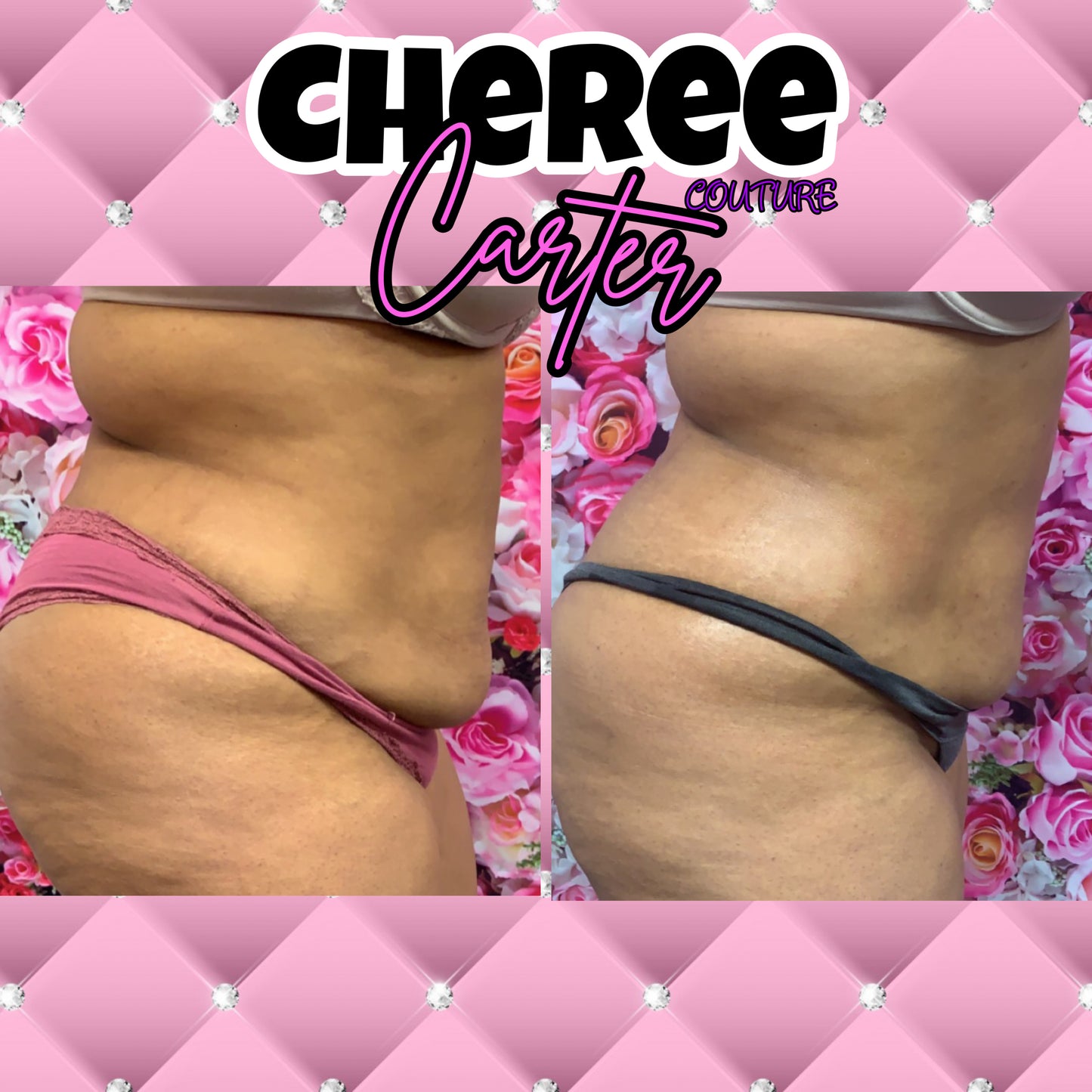 Cavitation Lipo