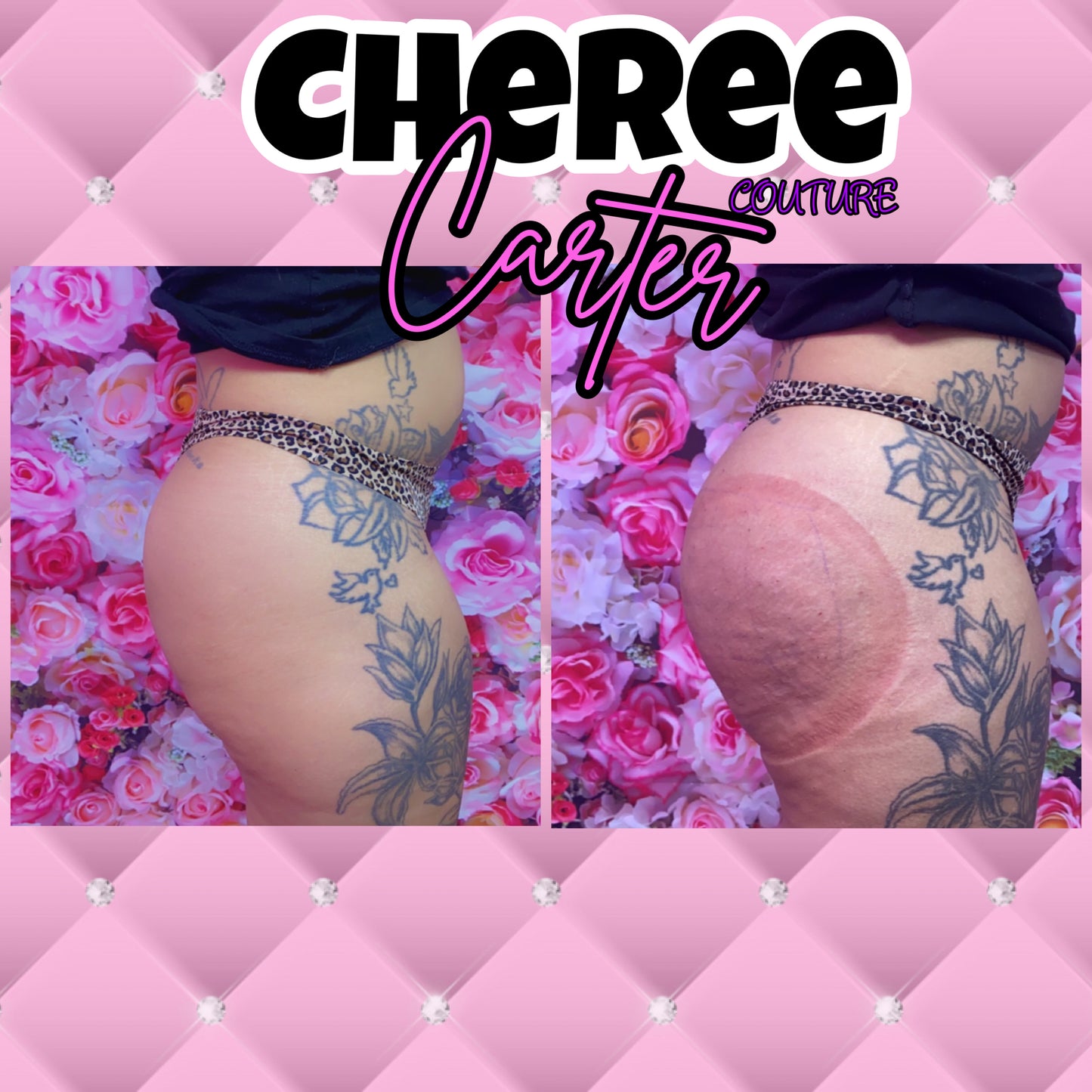 Needle-Free Butt Filler Training