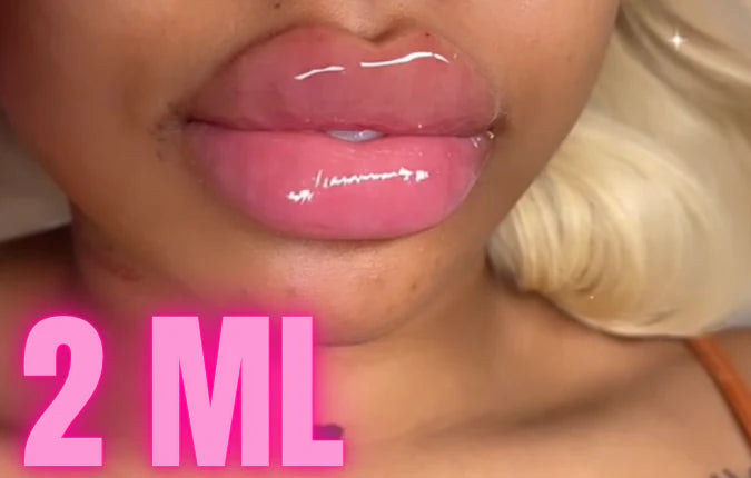 2ML Needle-Free Hyaluron Lip Filler