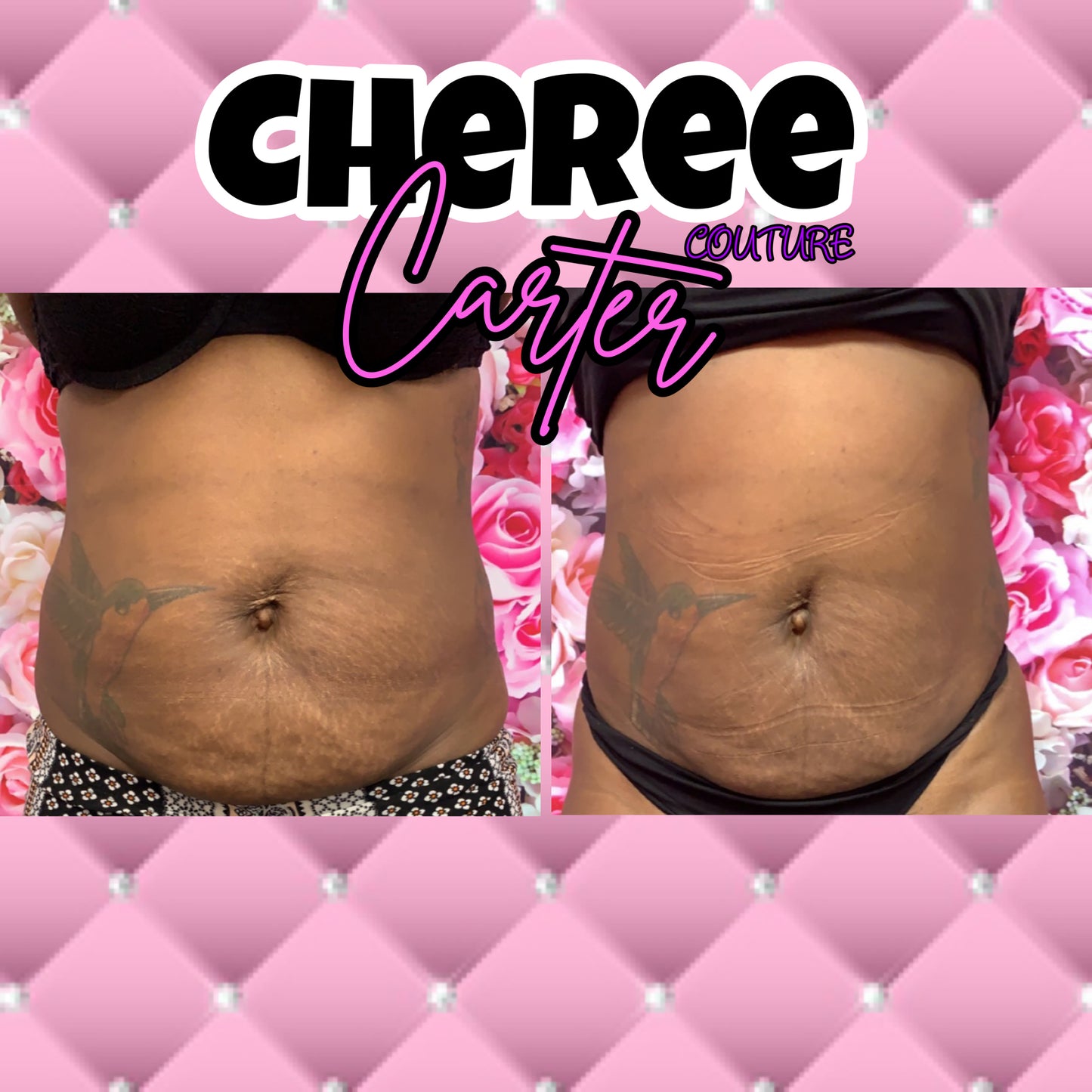 Needle-Free Liquid Lipo Shots